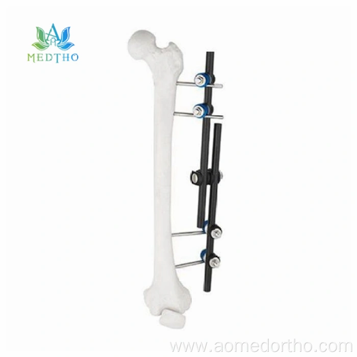 fractured femur treatment